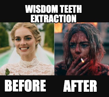 wisdom-teeth-extraction-before-after